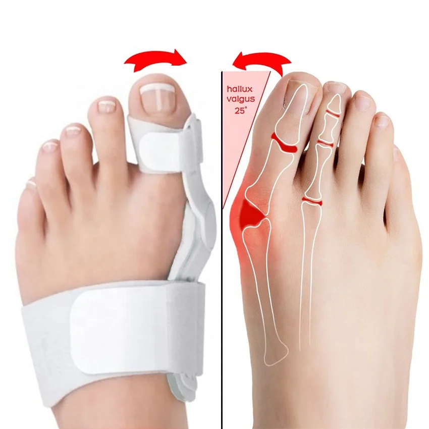 Grote Teen Bunion Spalk Hallux Valgus Orthesen Schoeisel