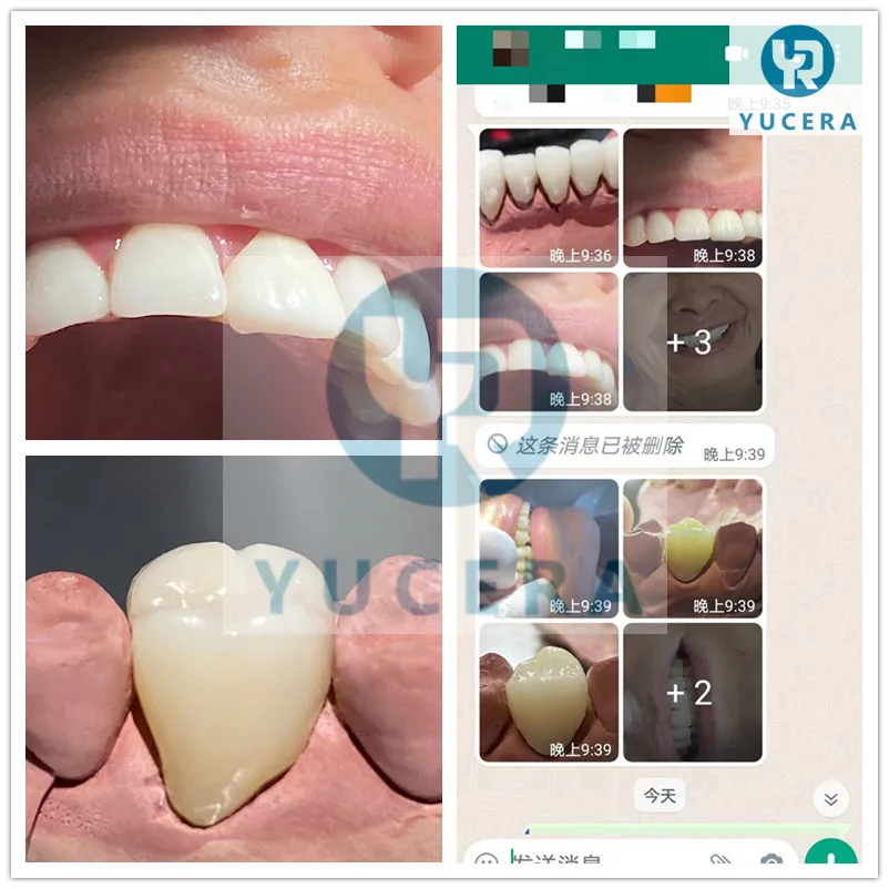 Yucera 95mm UT White Dental Zirconia Block for Grinding Machine for Dental Laboratory Use