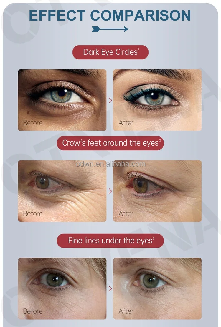 OTVENA Syringe Instant Tightening Wrinkle Eraser Eye Cream Face Lift  Wrinkle Skin Care Eye Cream