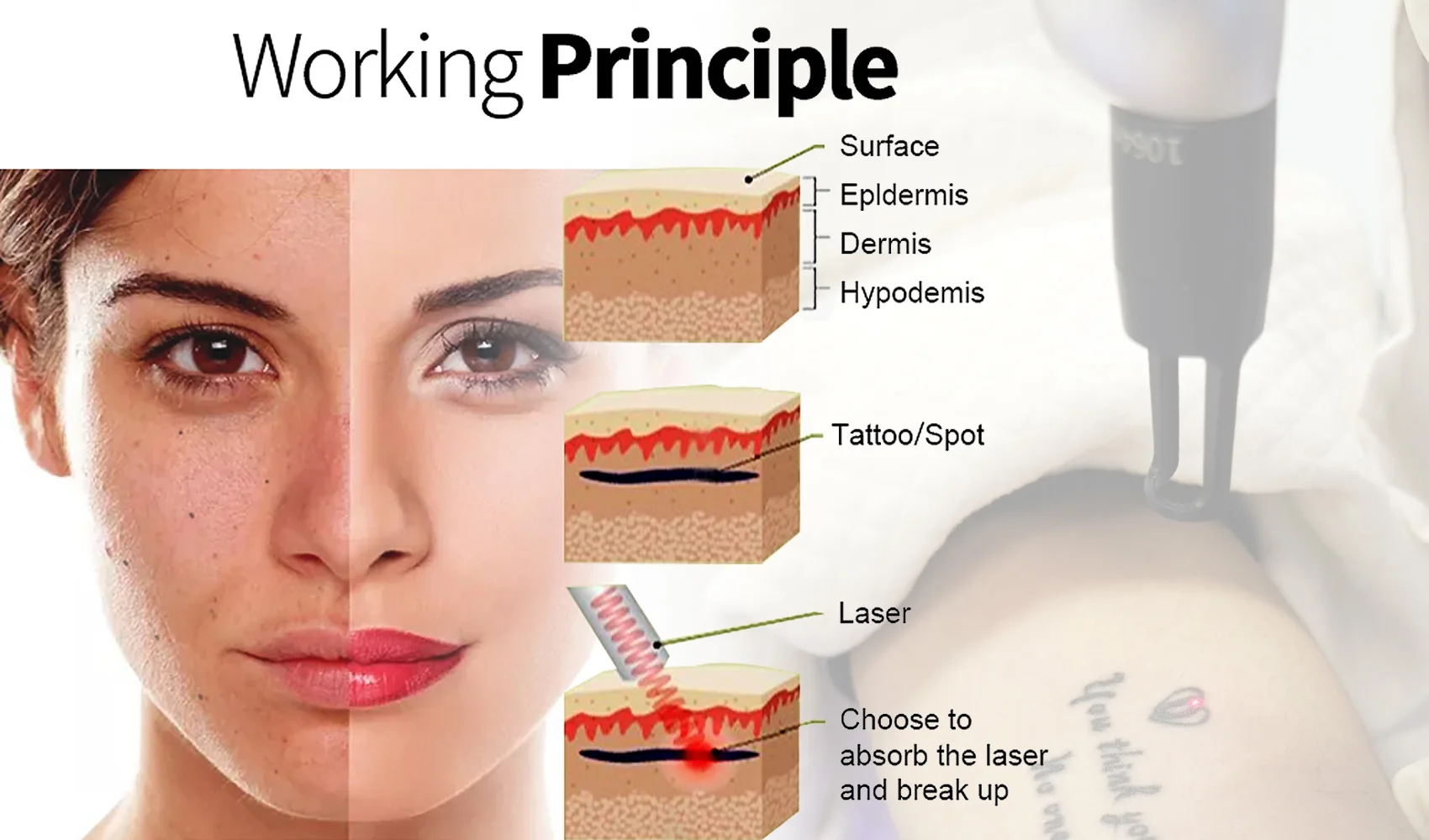 Laser Beauty Equipment Picosecond Laser Tattoo Removal Machines Removal ...