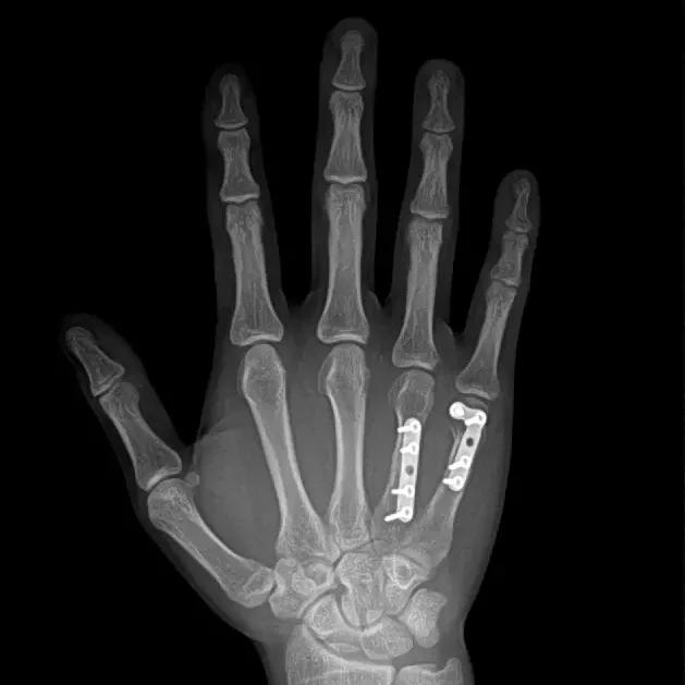 Medical Equipment Manufacturers 17 * 17 Inch X Ray Digital Wireless Detector,  Portable Smart X-ray Flat Panel