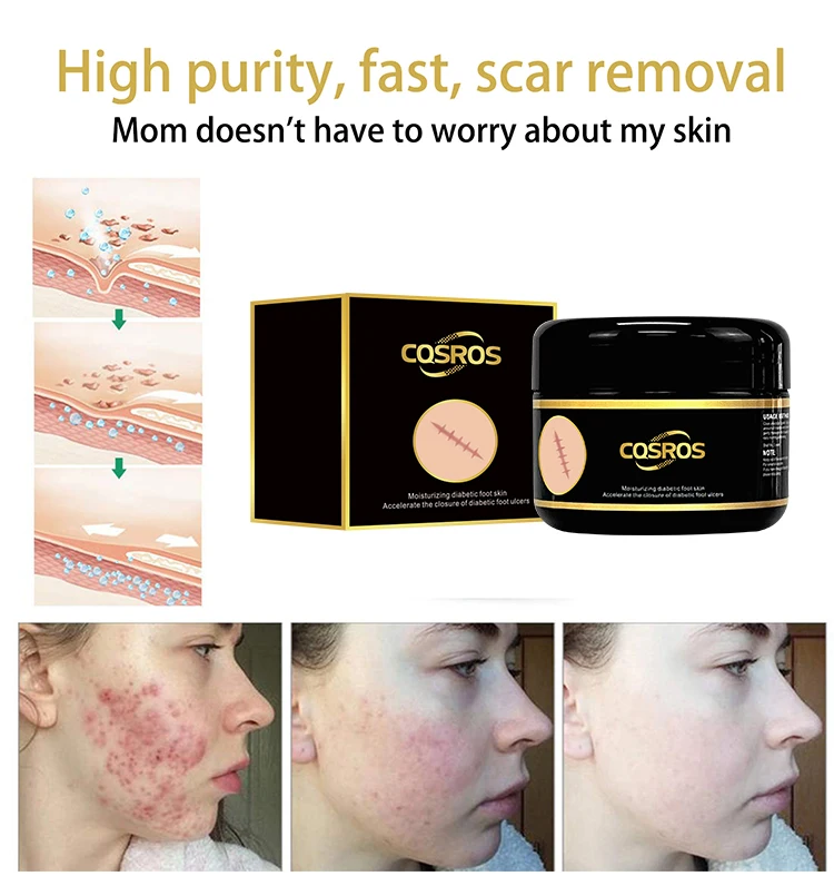 Oem Odm Fast Anti Acne Anti Spots Treatment Stretch Marks Repair Acne