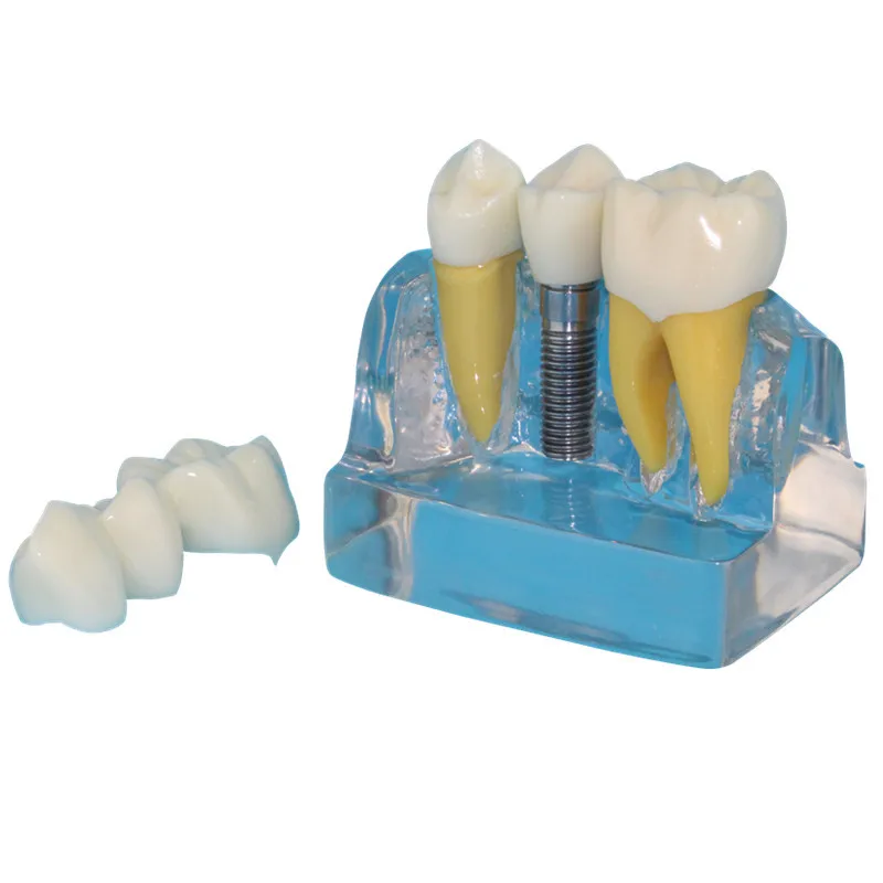 Transparent Implant Dental Model With Restoration And Pathologies For ...