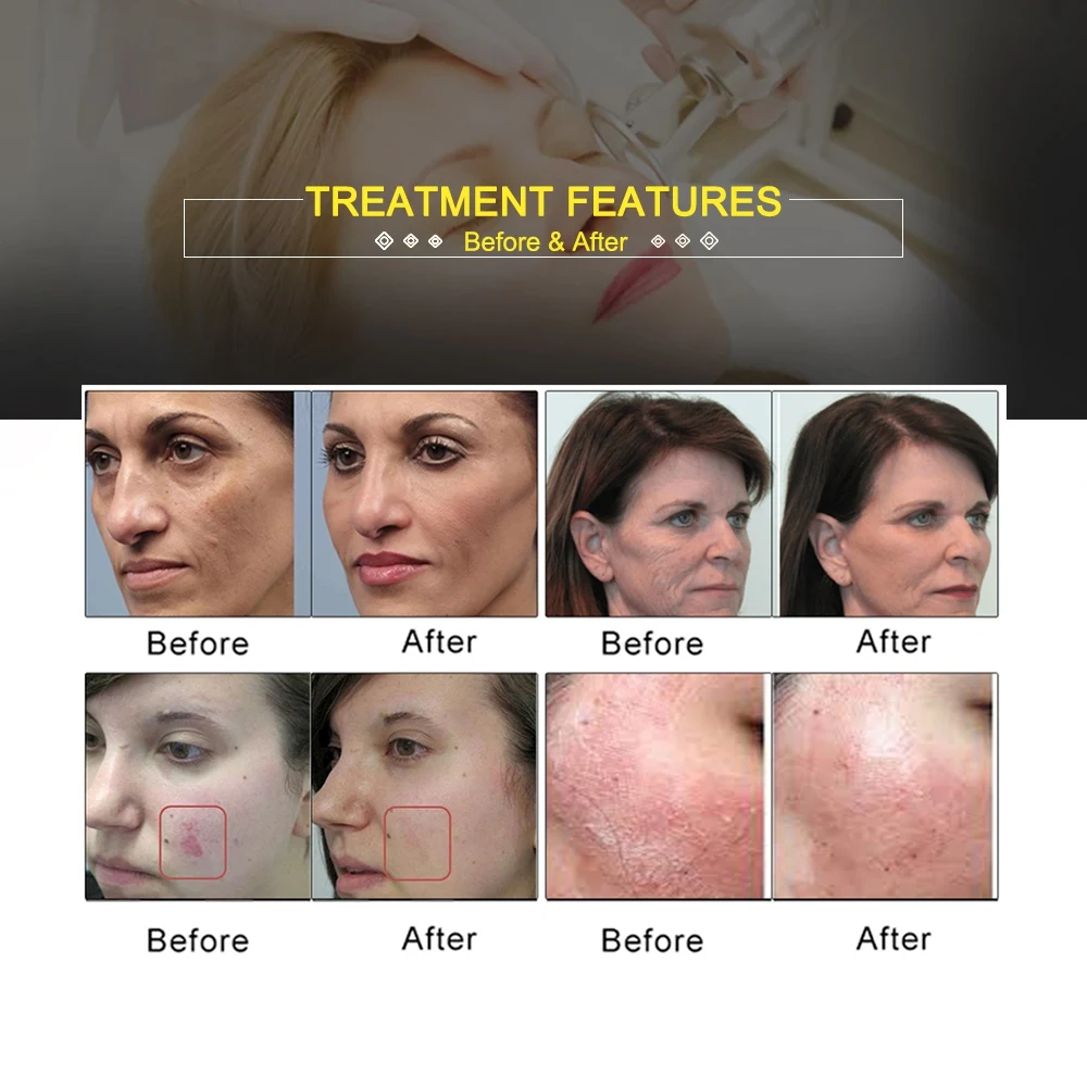 Before And After LÃ¡ser Fraxel Dual Precio Fraxel Laser Precio LÃ