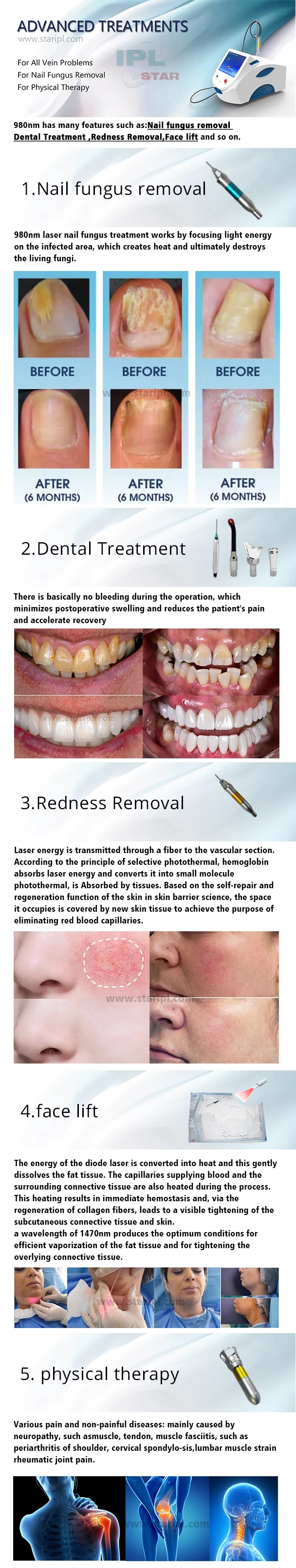 980nm Diode Laser Physical Therapy Red Blood Spider Vein Removal MachineVascular Spider Veins Blood Vessels Removal