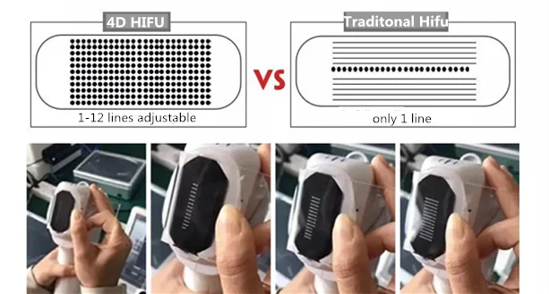 4D hifu