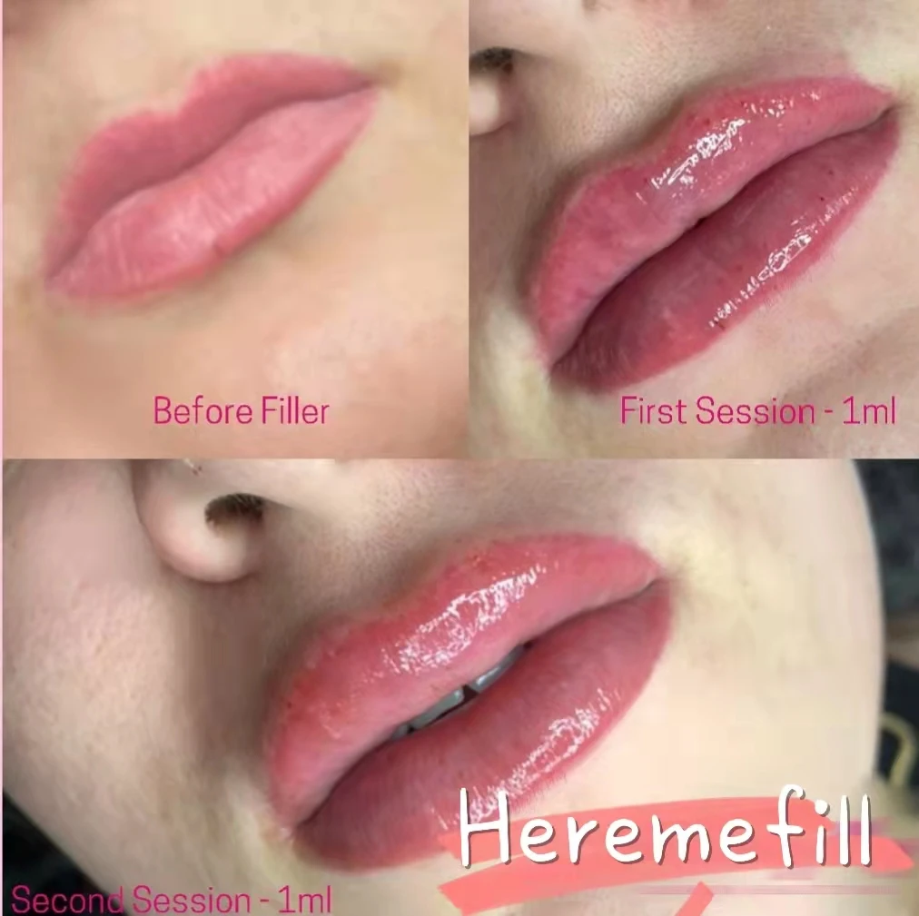 Hot sale acido hialuronico inyectable dermal lip filler injection hyaluronic acid filler for lip injections