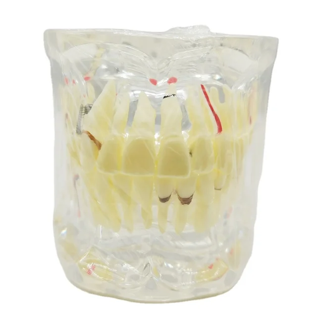 Hot Selling Oral Pathological Dental Model  M4001-1 Adult Pathological Model