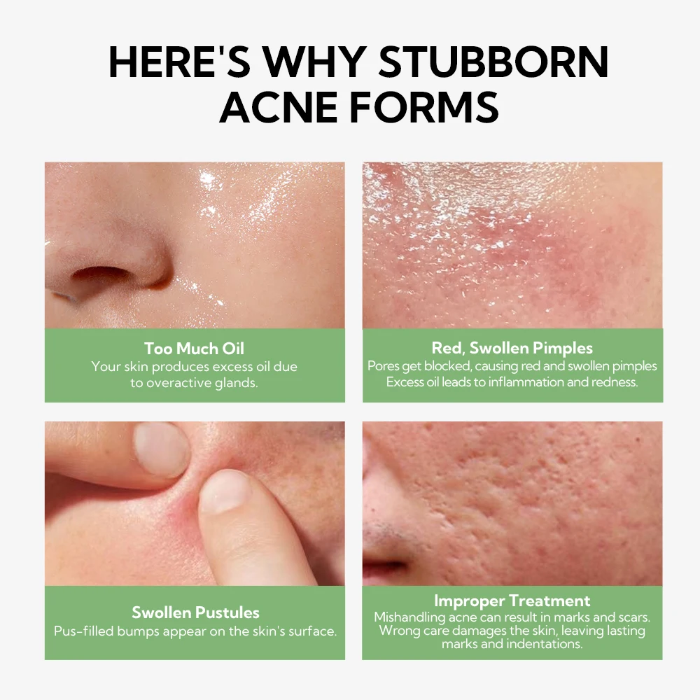 Lanbena Hot Sales Pore Reducing Face Minimizing Face Serum Anti Acnes Cream factory