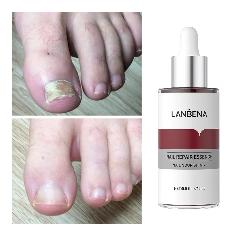 LANBENA Hot Sale Nail Essence Anti Fungus Nail Care Nourish Repair Serum