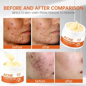 Dark Spot Repair Cream  Acne Repair Cream Acne Cream Acne Gel  Acne Repair Cream Acne Cream Acne Gel