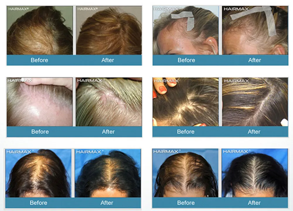 272 диодных лазерных колпачков для роста волос восстановления лазерная колпачок лечения