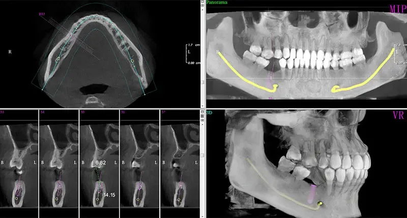 Dental Panoramic Device Pro 2D Dental Panoramic Device Pro 2D