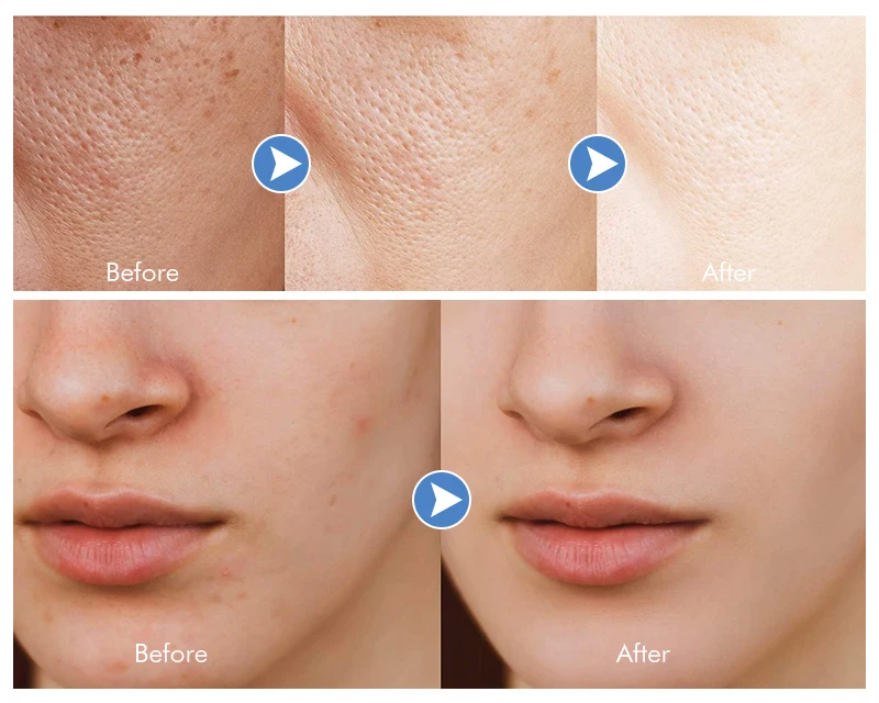 Customize Aha Bha Pimples Dark Spots Peeling Face Wash Toner Serum