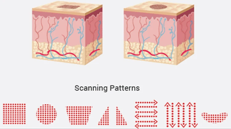 KES RF Tube For Co2 fractional laser machine Scars pimples spots large pores stretch marks Vaginal treatment