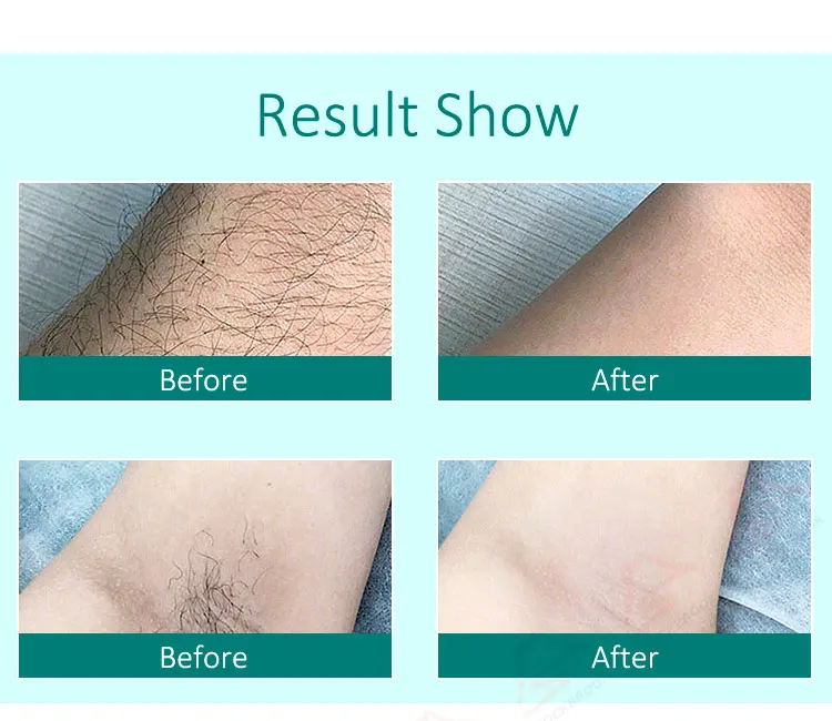 Ready To Ship  New Facial Body Skin Beauty Permanent Men Price Laser Hair Removal Home Use Ipl Machine Women Men