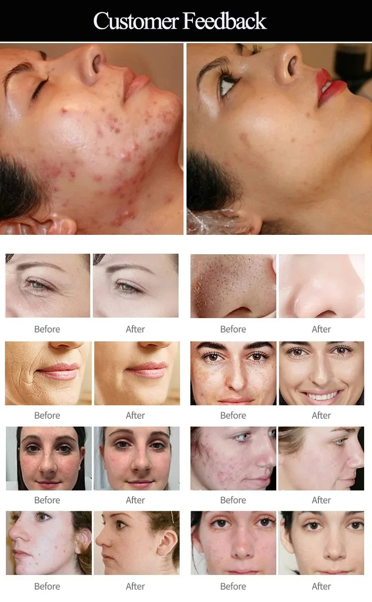 Professional Hydrafacial Machine with 2 Years Warranty 17 Handles and Vacuum Pressure ≥100Kpa for Advanced Skin Care