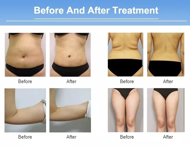 Discover the LipoSonic HIFU Machine for non-invasive fat reduction and body sculpting. Advanced ultrasound technology delivers targeted fat destruction, skin tightening, and visible slimming results for professional clinics and med spas. LipoSonic HIFU Machine for Body Slimming Weight Loss