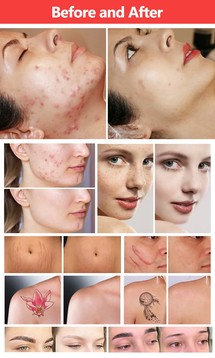 2 in 1 CO2 Fractional Laser+ Q Switch Skin Care Machine for Skin Carbon Peel Professional Fractional Skin Firm