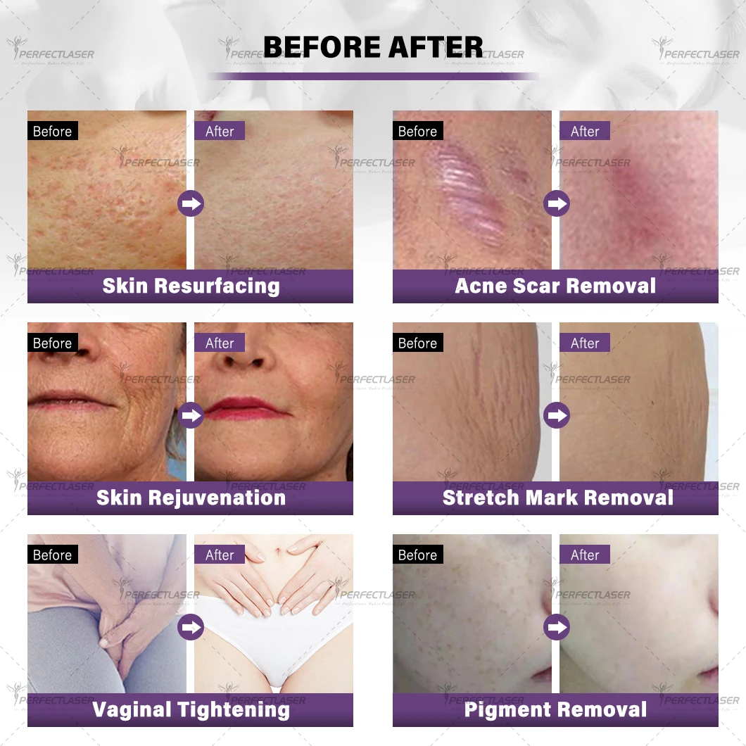 Perfectlaser 2025 New OEM 10600 nm Fractional Co2 Laser Medical Vaginal Tightening Co2 Fractional Laser Machine