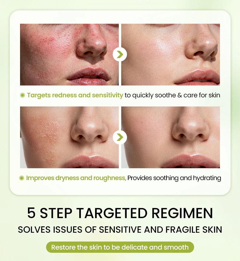 Icesea Australia Chamomile Facial Skin Care Set for Sensitive Skin-Moisturizer Soothing Redness & Dryness Relief(pic6)