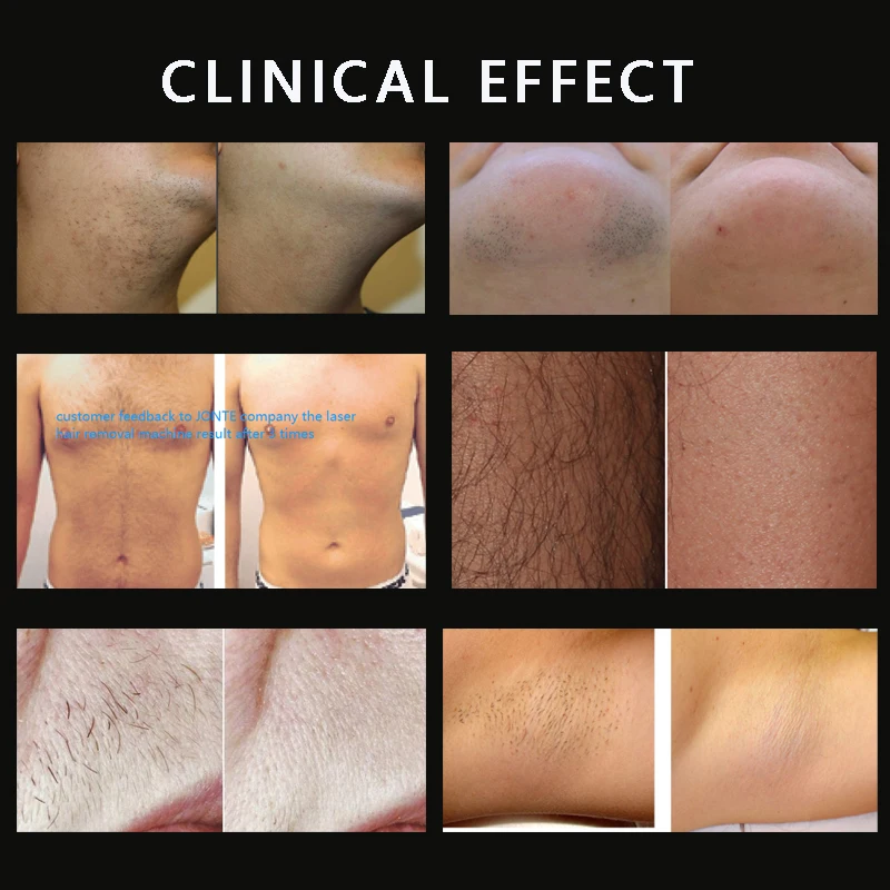 CE Certified Medical Laser Machine for Hair Removal Skin Tightening 1200W Diode Lasers 808nm 755nm 940nm 1064nm Diode Laser