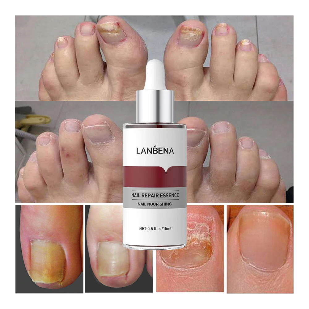 LANBENA Hot Sale Nail Essence Anti Fungus Nail Care Nourish Repair Serum supplier
