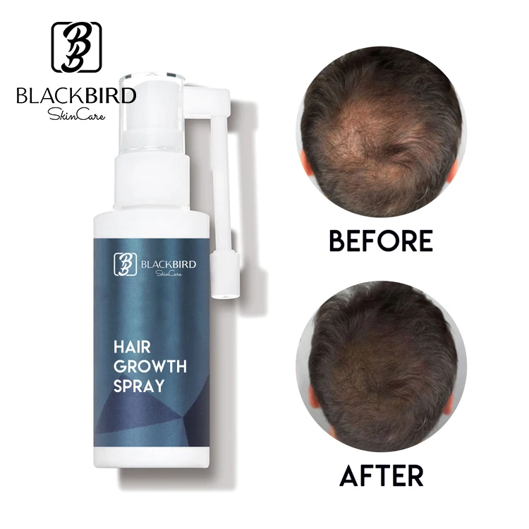 Private Label Effective Natural Ingredients Hair Growth Treatment Mousse Hair  Regrowth For Men Women Hair Loss Treatment - Buy Hair Regrowth,Hair Growth,Hair  Growth Treatment Product on 