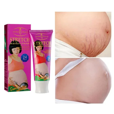 stretch marks repair