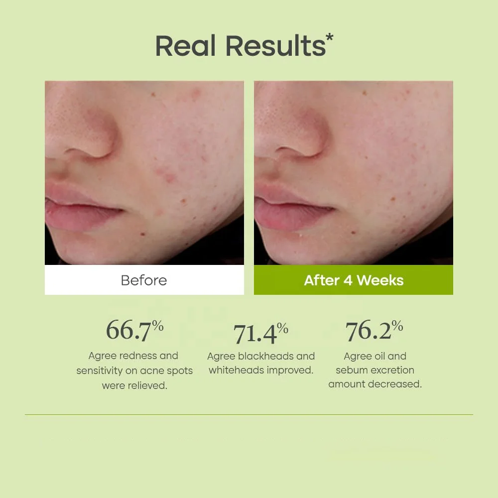 Private Label 30ml Face Superfruit Serum Clarifying Solution Repairing Acne Prone Skin Korean Skin Care Facial Serum