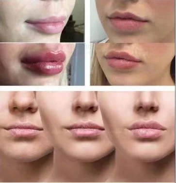 Fine line derm deep ultra deep wrinkle dermal filler injection face fillers injectable hyaluronic acid lip filler 2ml