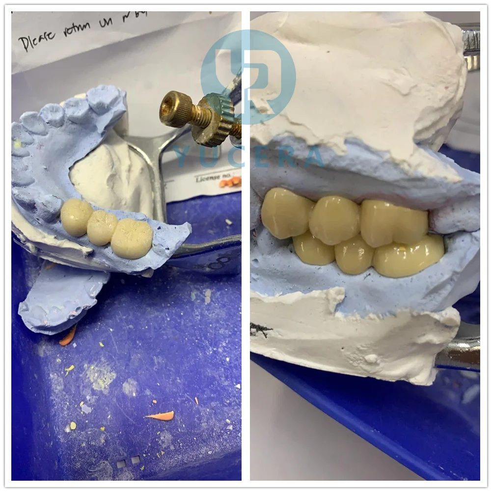 Good Price Dental Zirconia Block Dental Zirconium Blank Ht White Zirconia Disc for Aesthetic restoration