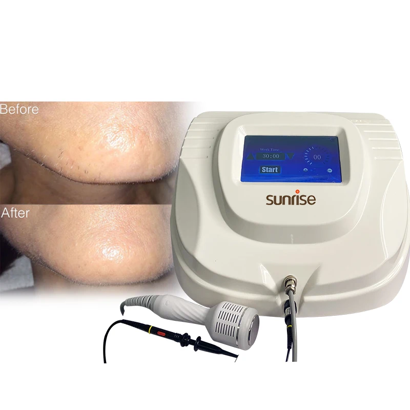 美容電気脱毛 ELECTROLYSIS BASIC Amazon.co.jp: Clean and Easy Deluxe Home Electrolysis 家庭用