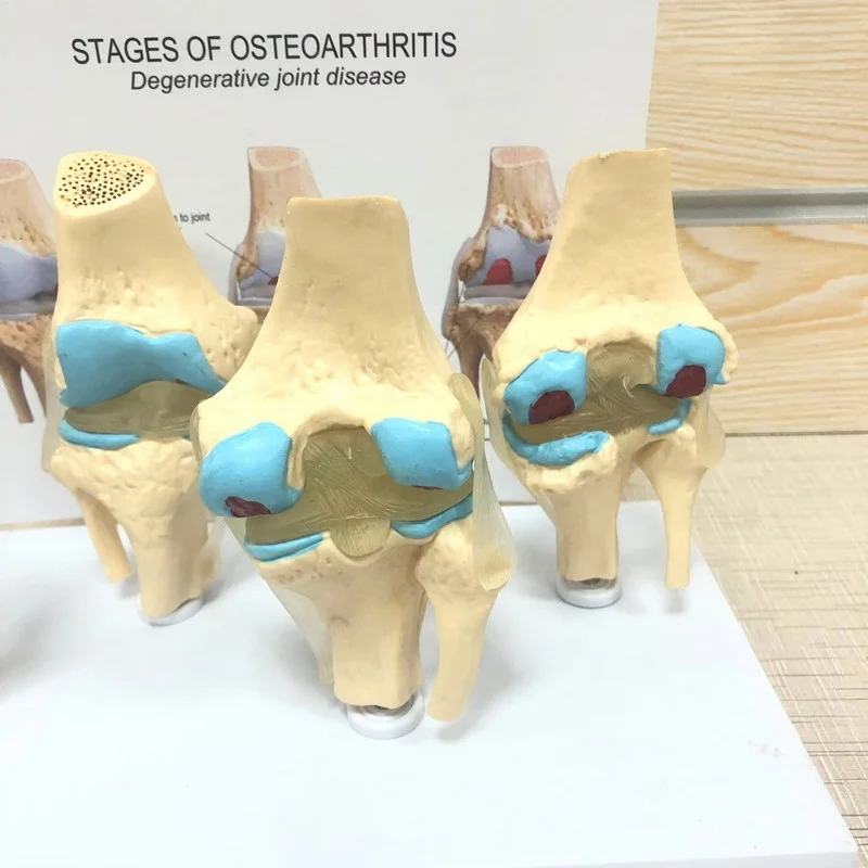 Высококачественная медицинская модель анатомии человека, этапы остеоартрита