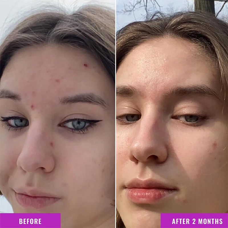 Facial Serum, Suitable for Acne Skin Brightening and Moisturizing Facial Skin Care Niacinamide Serum OEM(pic2)