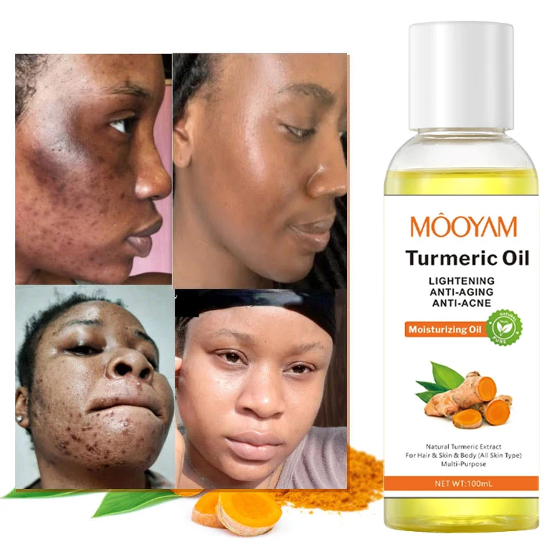 Customized Turmeric Oil Face Whitening Lightening Acne Dark Patches ...