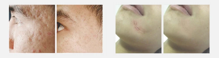 Apolo Skin Rejuvenation Skin Resurfacing 1550nm 1927nm Fiber Laser Systems for Sale details