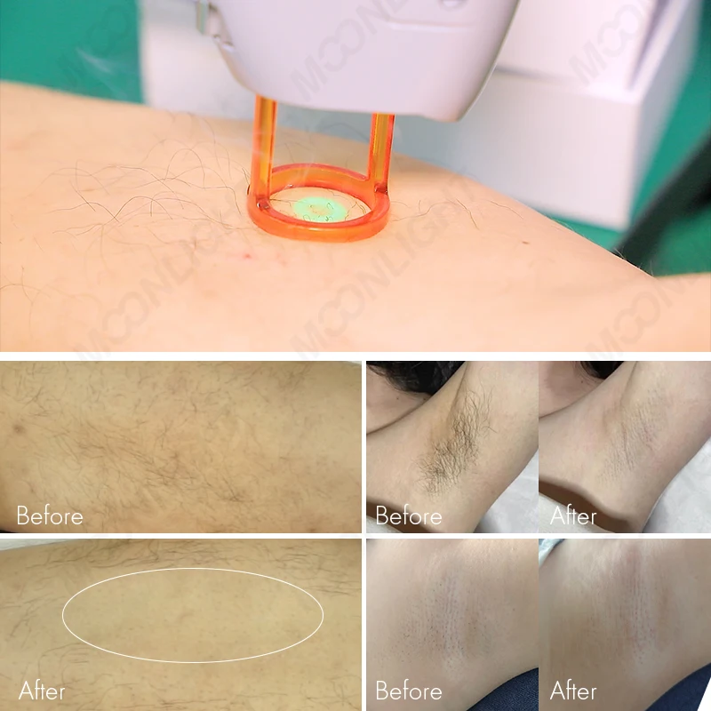 Best Alexandrite Crystal Laser Rod Hair Removal Machine Manufacturer Motus Gravity Lamp 755 nm 1064 nm Machine Prix