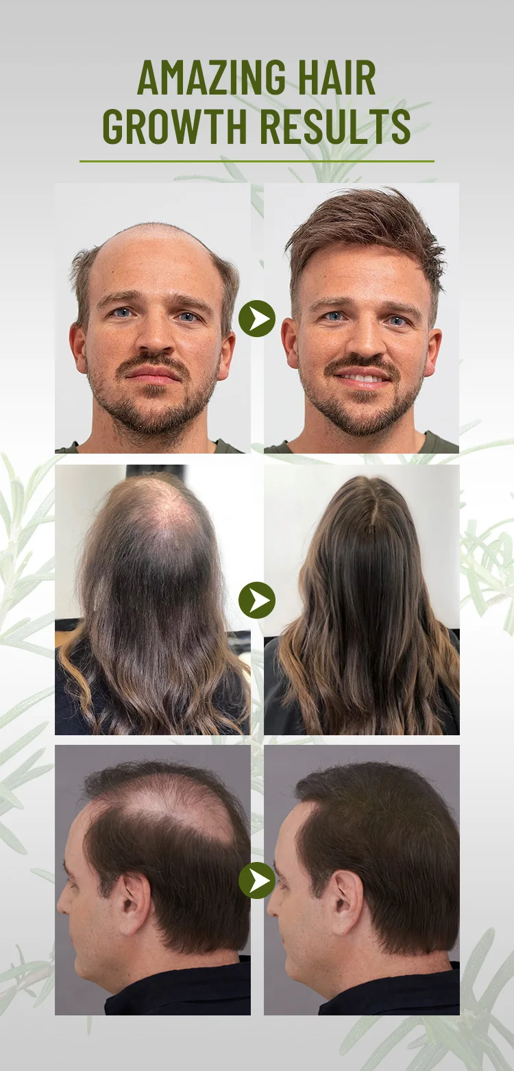 High Quality Rosemary Hair Essential Oil Hair Regrowth Serum Hair Care