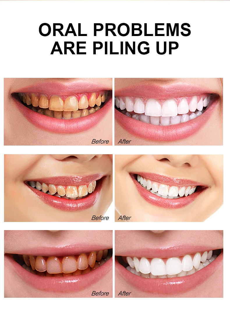 Teeth Whitening Essence – Tartar & Stain Removal