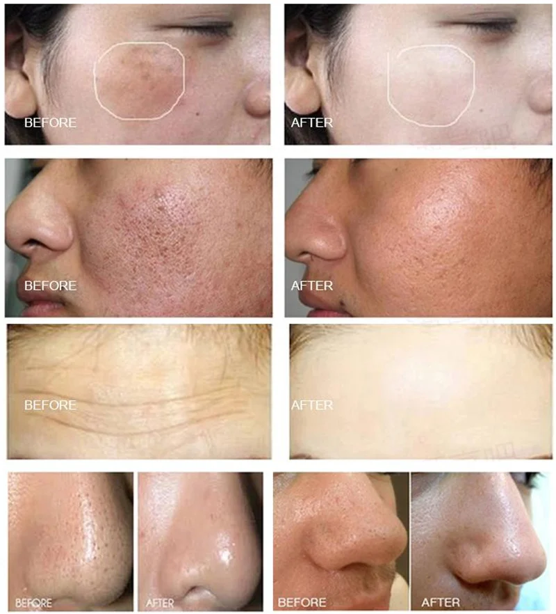 ZS Big Promotion 14-In-1 Hydra Dermabrasion Machine Water Oxygen Peeling Microdermabrasion Korea Skincare Machine for Spa