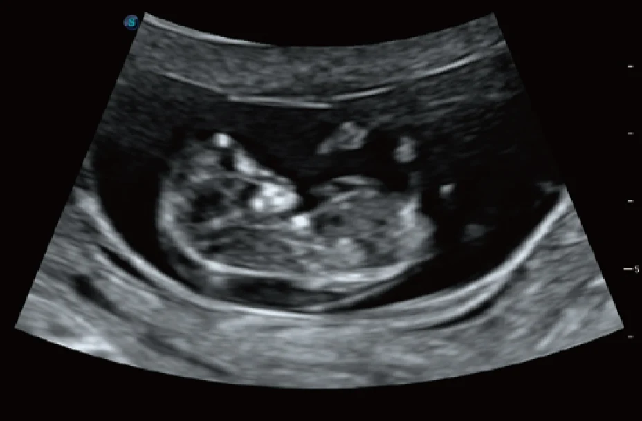 Sonoscape P20 Mobile 3D/4D Real-time Color Panoramic Doppler Trolley Ultrasound Machine details