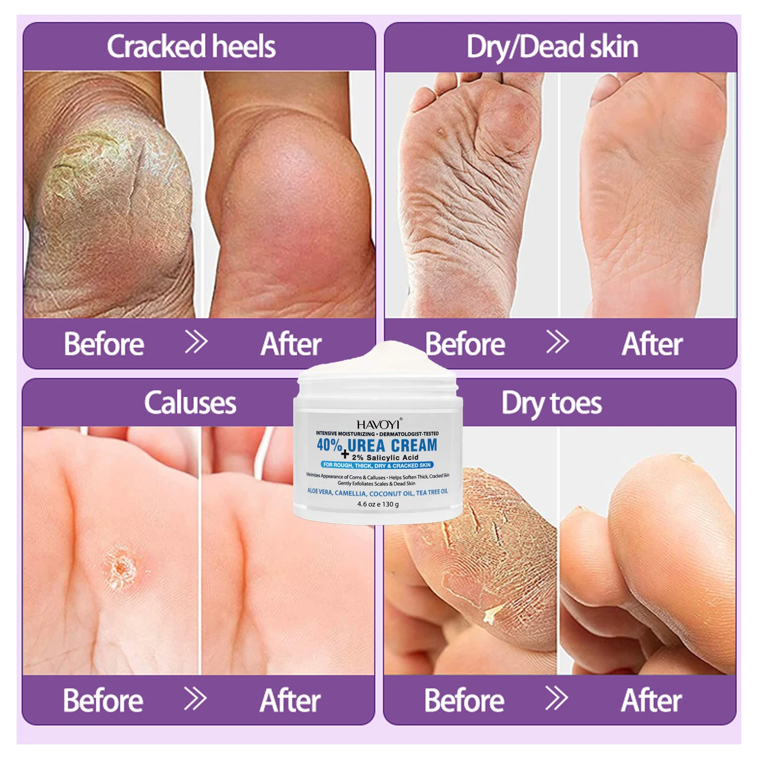 Hands & Feet Care Feet Cream Foot Cream Itchy Dry Feet Extreme