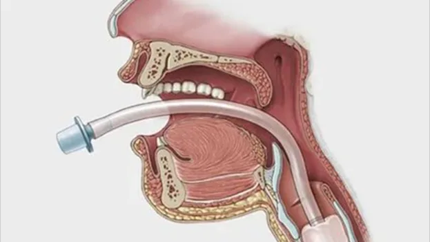 professional supplier visual tracheal intubation machine