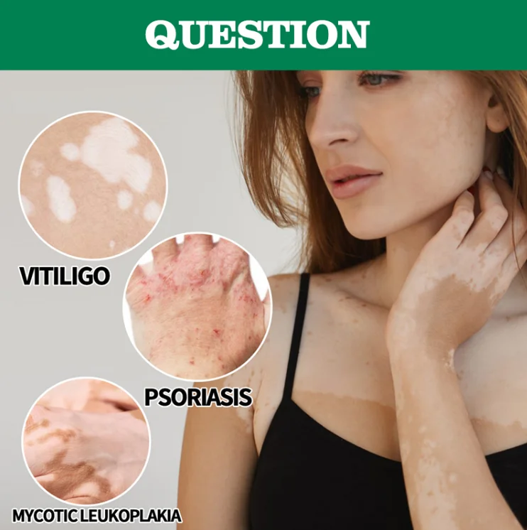 White Spot Removing Body Herbal Skin Care Relief Cream White Spot Removing Body Herbal Skin Care Relief Cream