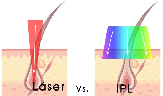 IPL VS laser.jpg