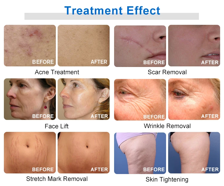 Shop professional RF microneedling replacement cartridges (10 pin, 25 pin, 64 pin, nano). стерile, disposable, compatible with most RF devices. Ideal for skin tightening & acne scars. RF Microneedling Replacement Cartridges 10 25 64 Nano | Professional Disposable Tips