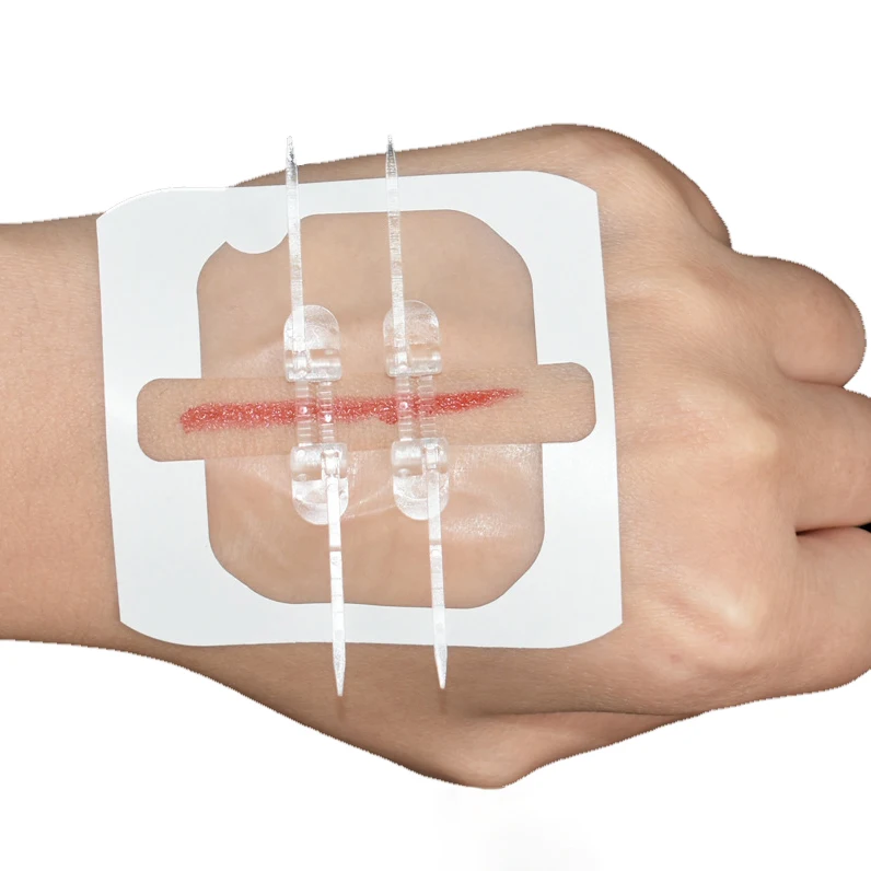 Wound Device Zip Wound Closure Wound Splice Closure