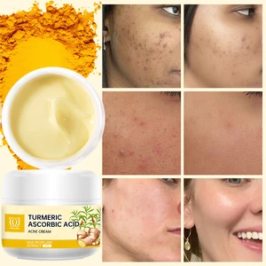 Acne-removing and Whitening Cream Specifically for Treating Acne and Fighting Pimples