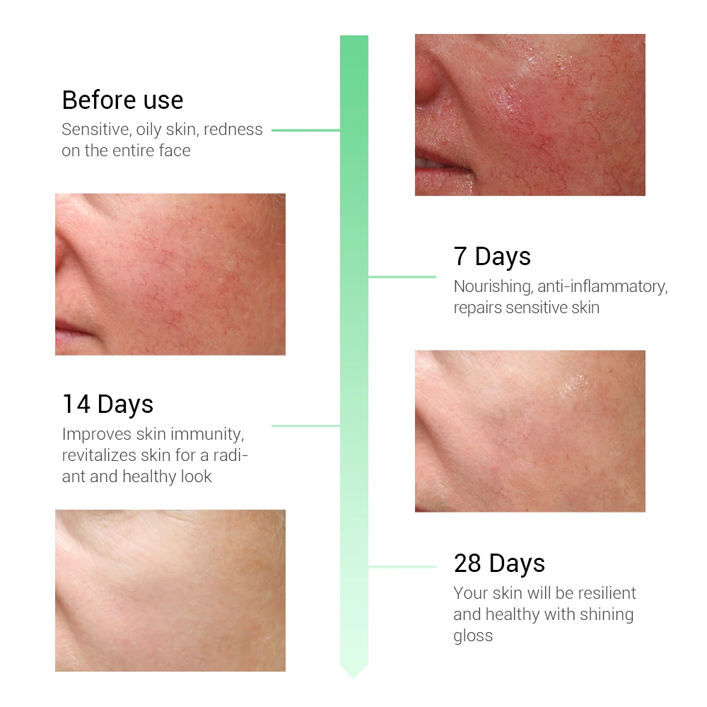 BREYLEE Repairing Serum Sensitive Skin Remove Fade Redness Treatment Soothing Whitening Face Skin Care Acne Scar Facial Serum